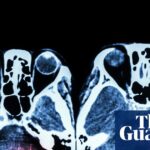 Access to round-the-clock stroke treatment remains limited throughout England.